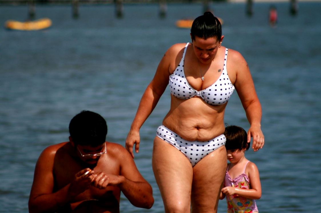 femme avec cellulite